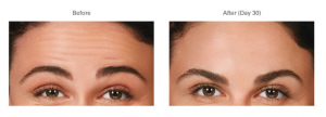 Botox Service in Virginia -2